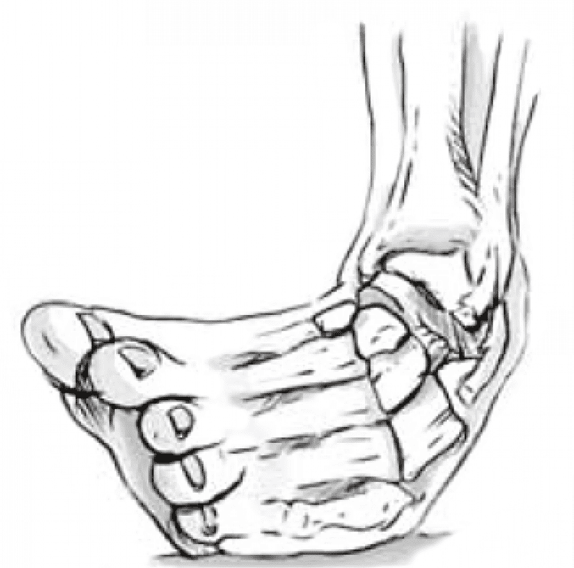 AIRCAST Ortesi Dinamica Bimalleolare di Caviglia AIR-STIRRUP AIRCAST per Distorsioni e Traumi Tibio Tarsali - immagine 5